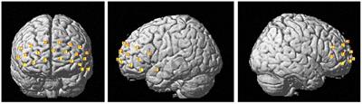 Functional near-infrared spectroscopy as a potential objective evaluation technique in neurocognitive disorders after traumatic brain injury